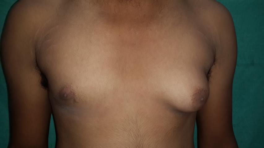 Gynecomastia surgery